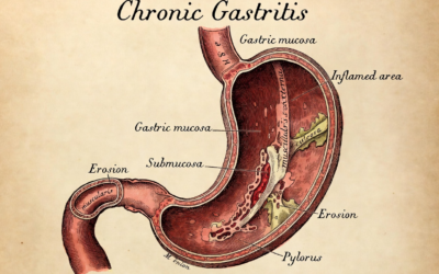 What Is Chronic Gastritis? Symptoms, Causes, and What Actually Helps